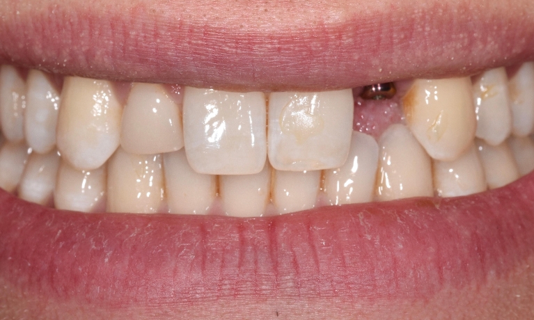 Vision Dental Mar Vista Before After Images